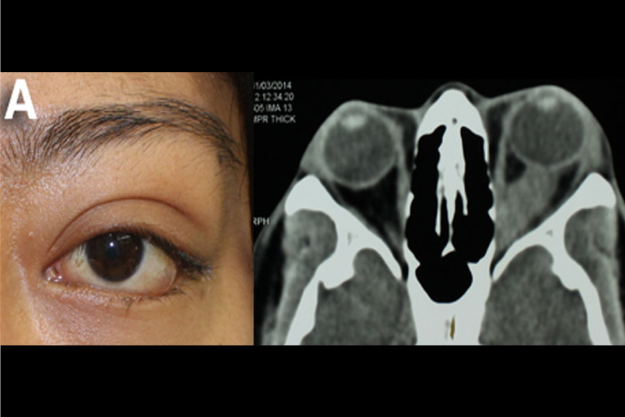 Expertos En Oncología Ocular Oftalmoclinicas